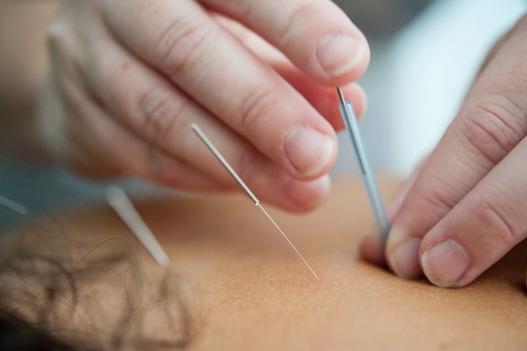 Acupunctura este un mod ineficient de a renunța la fumat