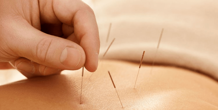 acupunctura împotriva fumatului